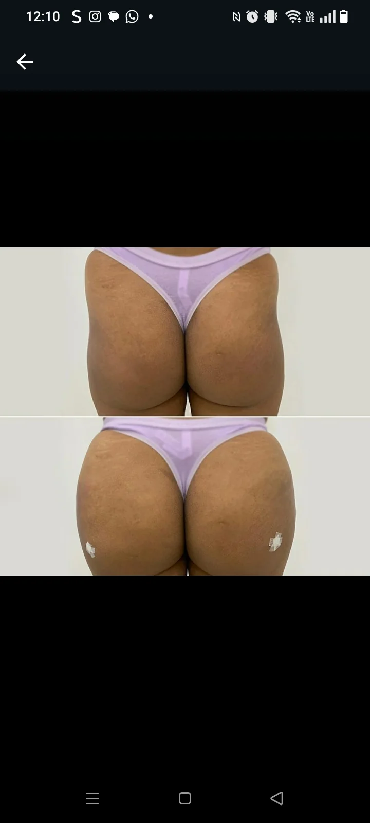 Antes e depois de volumização de glúteos com aumento de volume e projeção