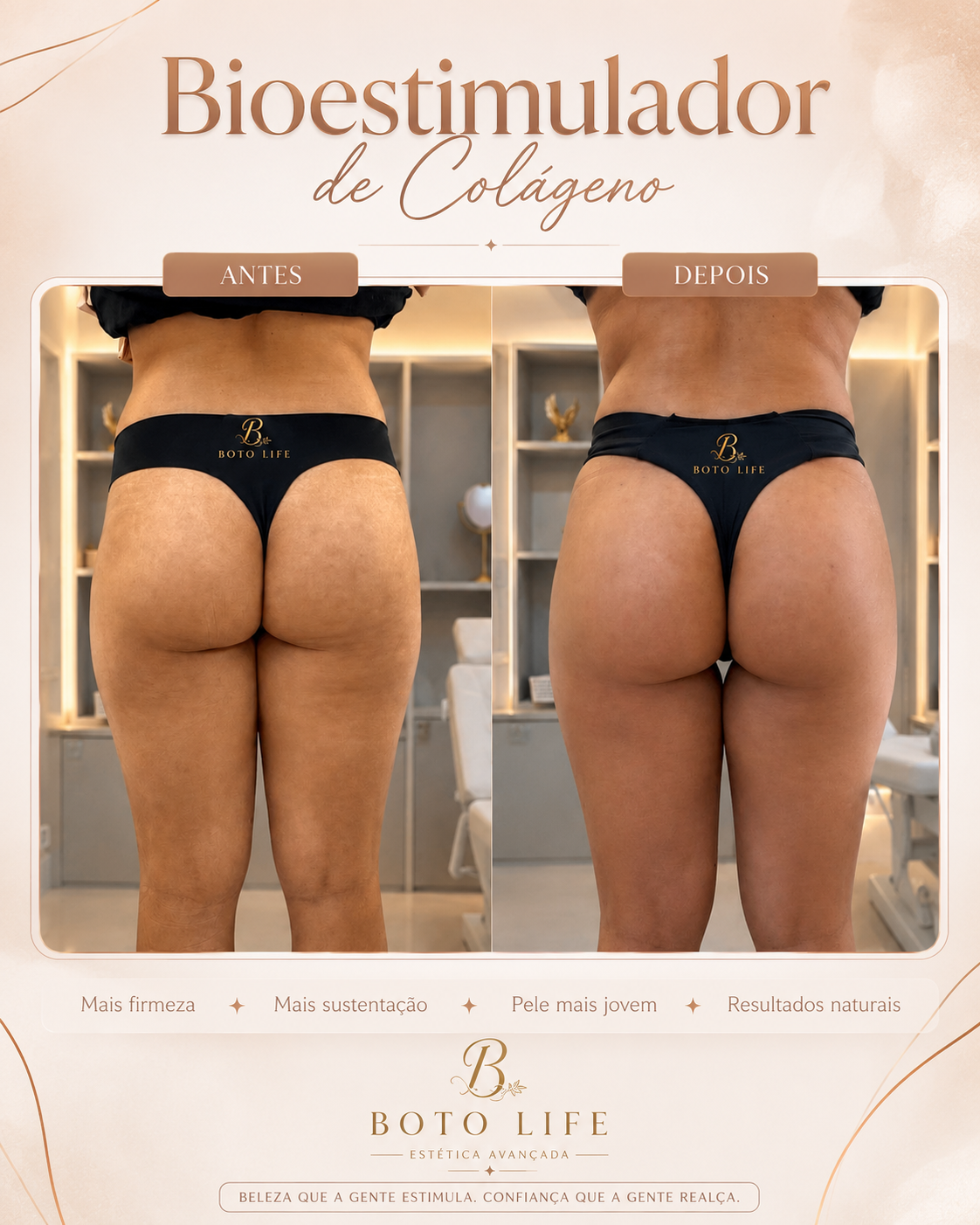 Flacidez glútea — quando o bioestimulador é a melhor opção