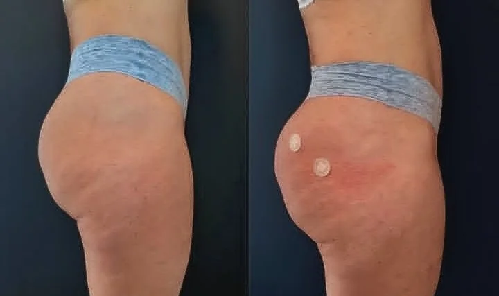 Antes e depois lateral de Hip Dips com suavização das depressões do quadril