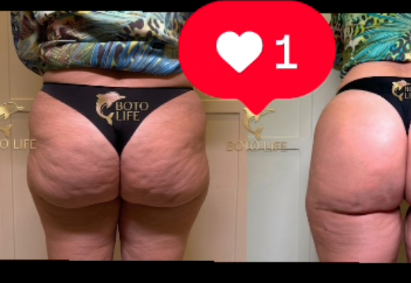 Flacidez ou celulite? Como identificar o que está incomodando no seu glúteo