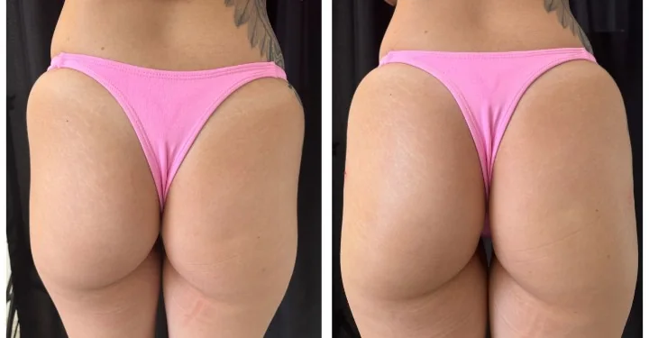 Antes e depois de harmonização do contorno glúteo