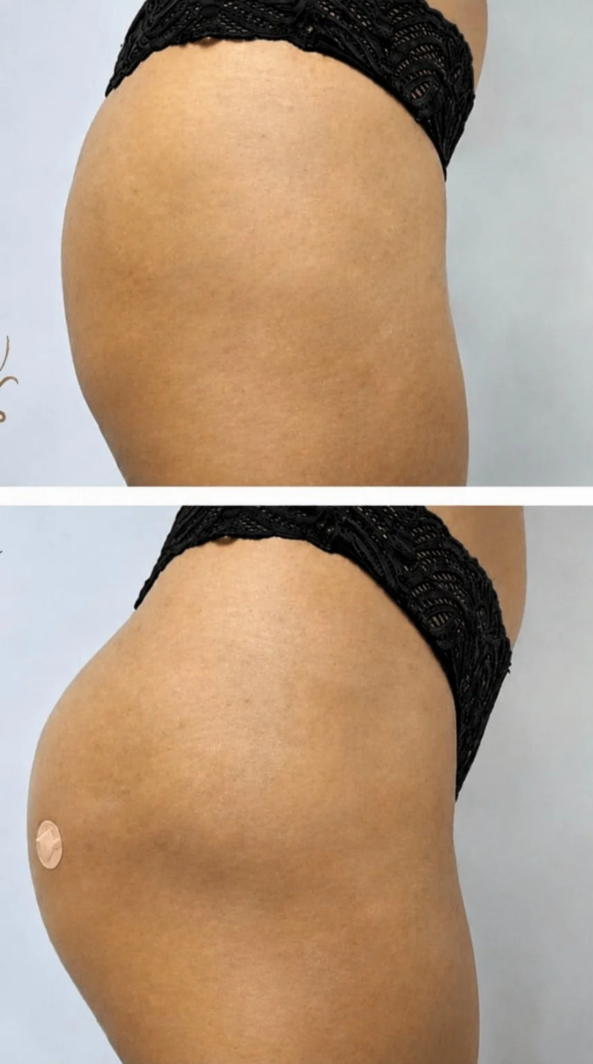 Antes e depois em vista lateral de volumização de glúteos