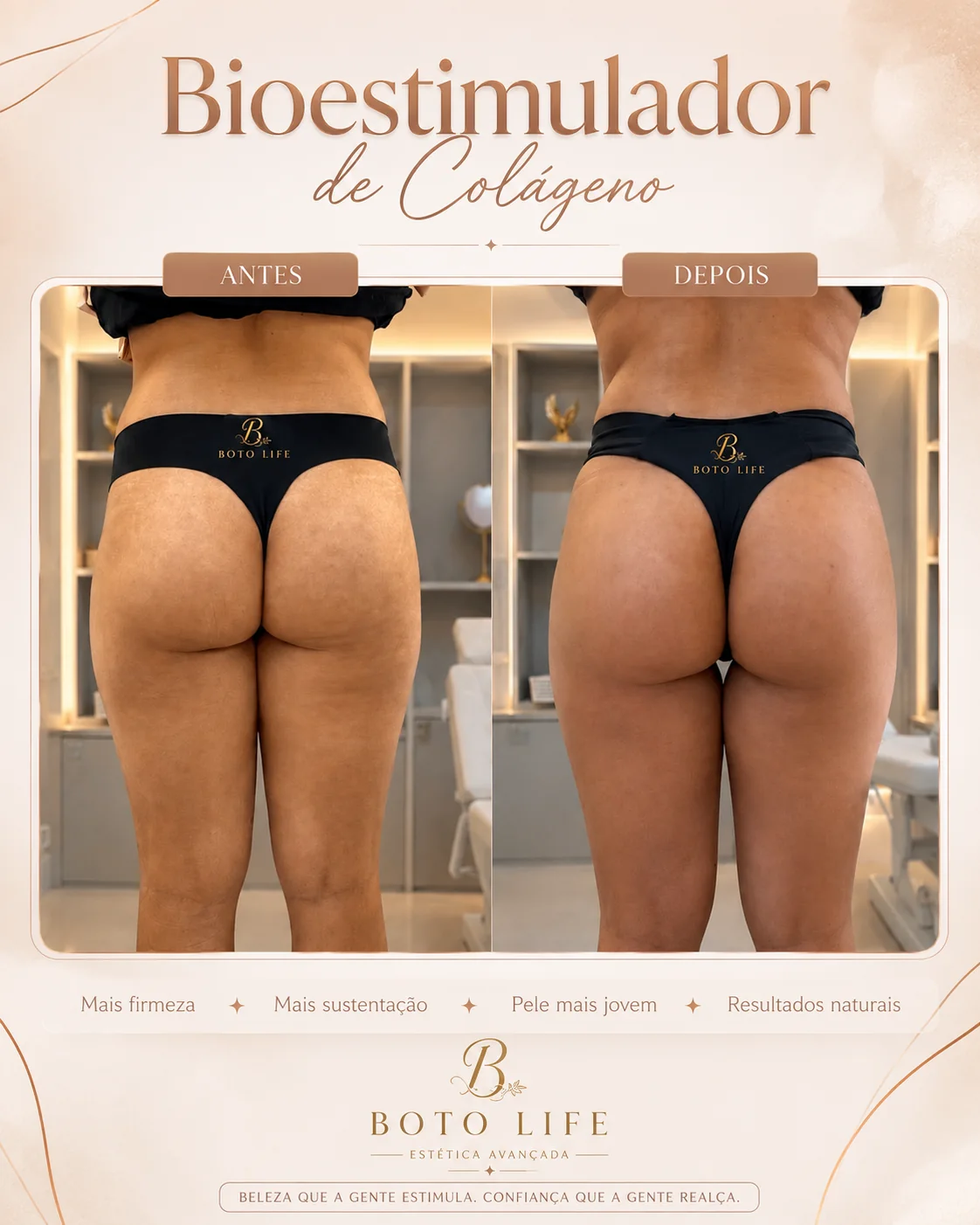 Antes e depois de bioestimulador de colágeno com melhora da textura da pele glútea