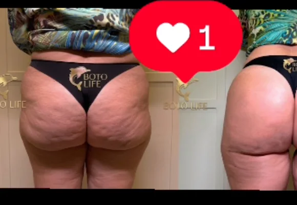 Antes e depois de melhora de celulite e flacidez nos glúteos com bioestímulo