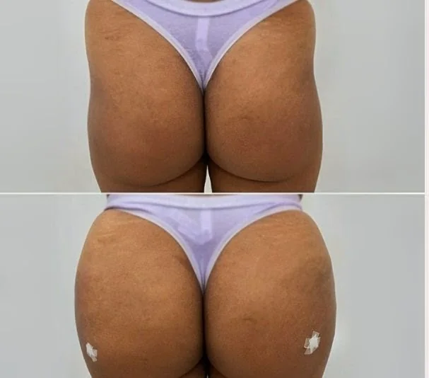 Antes e depois de volumização de glúteos com ganho de projeção